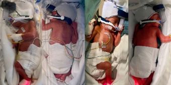 Bild: Viereiige Vierlinge im Perinatalzentrum Altona geboren