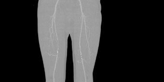Bild: Computertomographie beidseitiger Gefäßengen im Bereich der Oberschenkelarterien