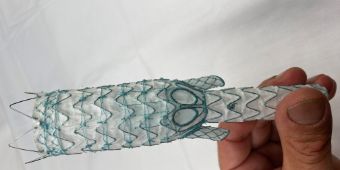 Der innovative Stentgraf-G-Branch vor dem Eingriff Bild: Der innovative Stentgraf-G-Branch vor dem Eingriff