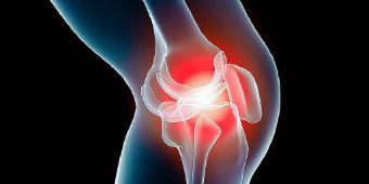 Arthrose im Knie