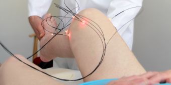 Laserakupunktur Akupunktur mit Laser