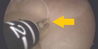 kuenstl-meniskus-ersatz