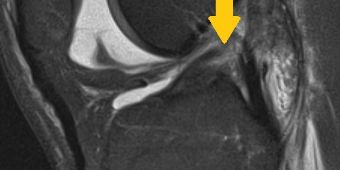 mr-schnitt-kreuzbandruptur 