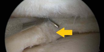 meniskusteilresektion