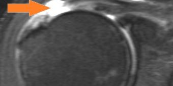 rotatorenmanschettenruptur