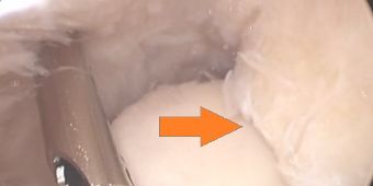 impingement-tibiaosteophyt