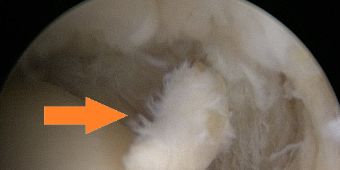 freier Gelenkkoerper