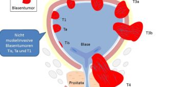 blasentumor tnk-klassifikation