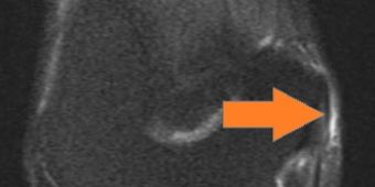 epicondylitis-pfeil02