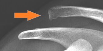 schultereckgelenksprengung