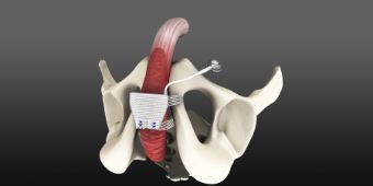 belastungsinkontinenz-atoms