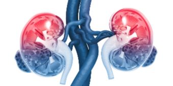 shutterstock_1400820953 Vinci Nierenteilresektionhp