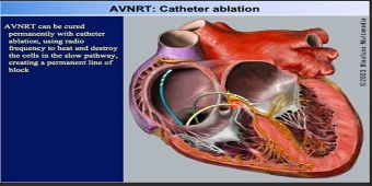 avnrt-catheter-ablation avnrt-catheter-ablation