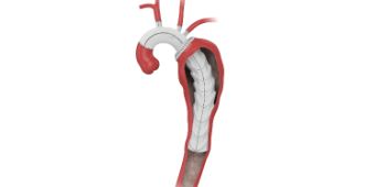 Bild: Aortenbogenersatz inkl. Prothesenversorgung