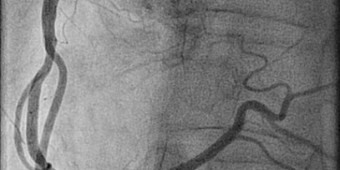 Abbildung: Koronarangiographie, die rechte Herzkranzarterie