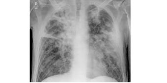 Bild: Infektiologie Röntgenbild