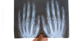 Röntgenbild Hand