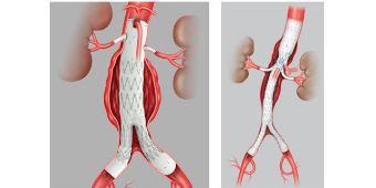 Downlaod Aortenstentgrafts