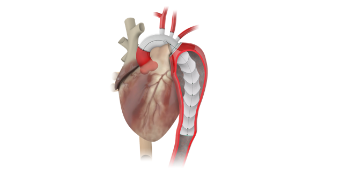 Download Bild Thoraflex Hybrid Heart Plexus 