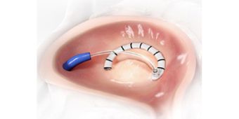 Cardioband Abbildung Cardioband