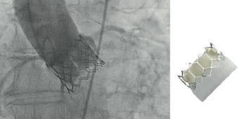 Abbildung Ballonexpandierende Herzklappe im Röntgenbild