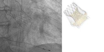 Abbildung Selbstexpandierende Herzklappe im Röntgenbild