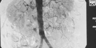 Angiographie Angiographie