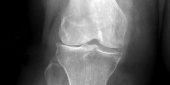 Kniearthrose im Röntgenbild