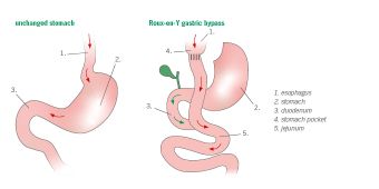 Roux_en_Y_Magenbypass_eng