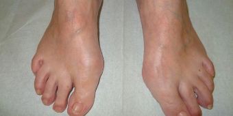 Hallux Valgus UCHHallux Valgus72