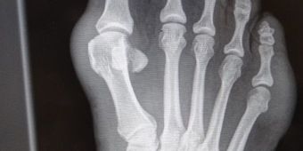 Röntgenbild Spreiz-Senkfuß mit Hallux Valgus UCHRöntgenbild Spreiz-Senkfuß mit Hallux Valgus72