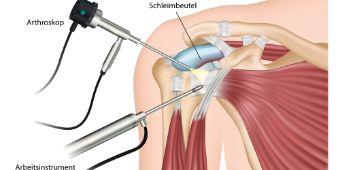 Arthroskopie Schulter Arthroskopie Schulter
