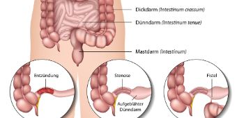 Morbus Crohn Morbus Crohn