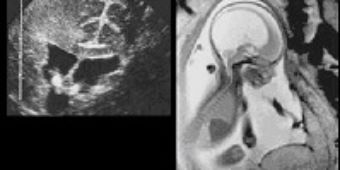 hydrozephalus_diagnostik hydrozephalus_diagnostik