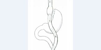 Bild: Skizze Magenbypass