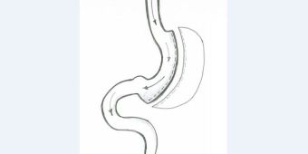 Bild: Skizze Schlauchmagen