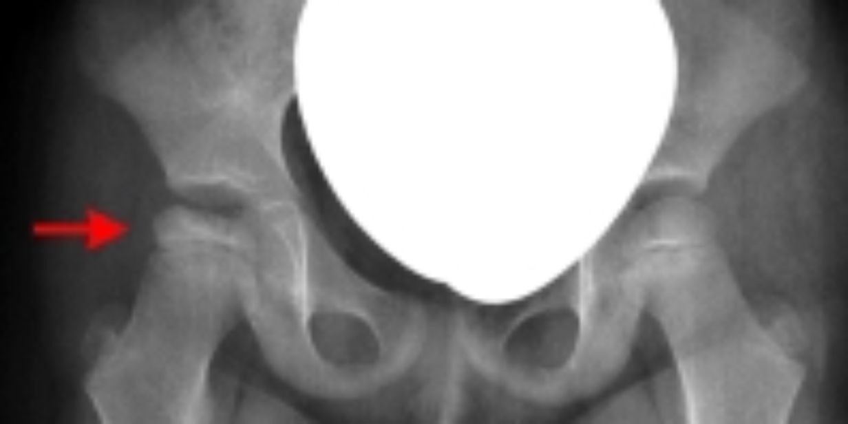 Morbus Perthes - Asklepios Kinderklinik Sankt Augustin