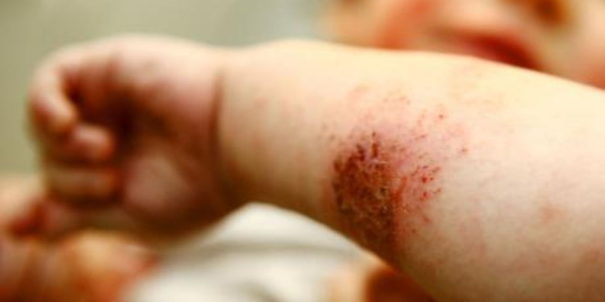 Neurodermitisschulung Klinik Weißenfels