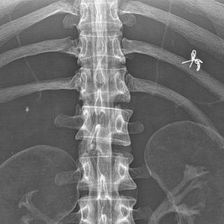 Röntgenaufnahme eines Abdomen