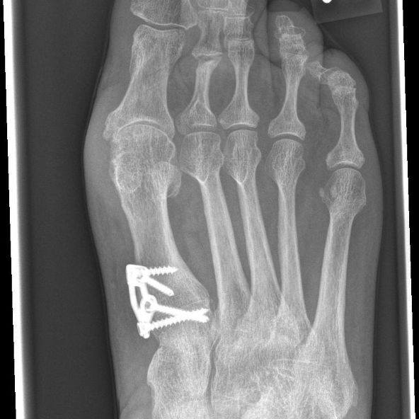 Hallux valgus Asklepios Klinik Birkenwerder Asklepios Klinik Birkenwerder