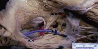 isthmus-ablation isthmus-ablation