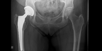 Pat. post op HEP
