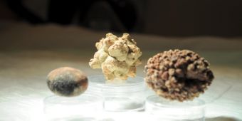 Harnsteine Harnsteine
