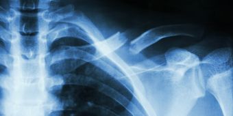 Diagnose Schlüsselbeinbruch Diagnose Schlüsselbeinbruch