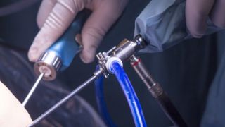 osteochondrale-transplantation