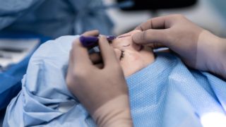 Man sieht sie Nahaufnahme einer Frau, die shclafend im OP-Saal liegt. Eine Hand des Chirurgen hält die Nase fest, die andere Hand zeichnet mit einem Stift das Operationsgebiet auf die Nase.