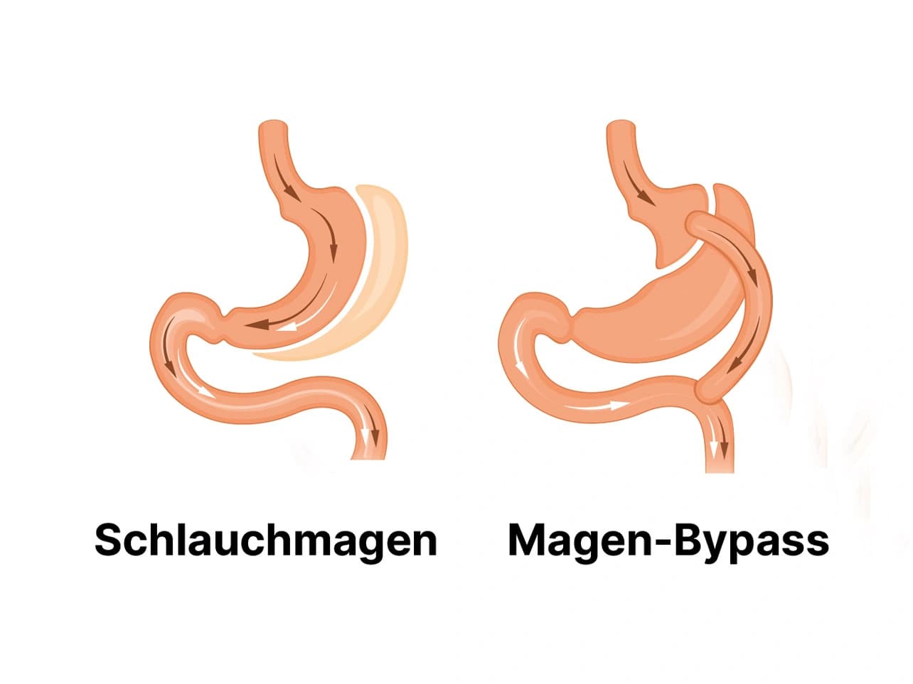Grafik: Schlauchmagen und Magen-Bypass