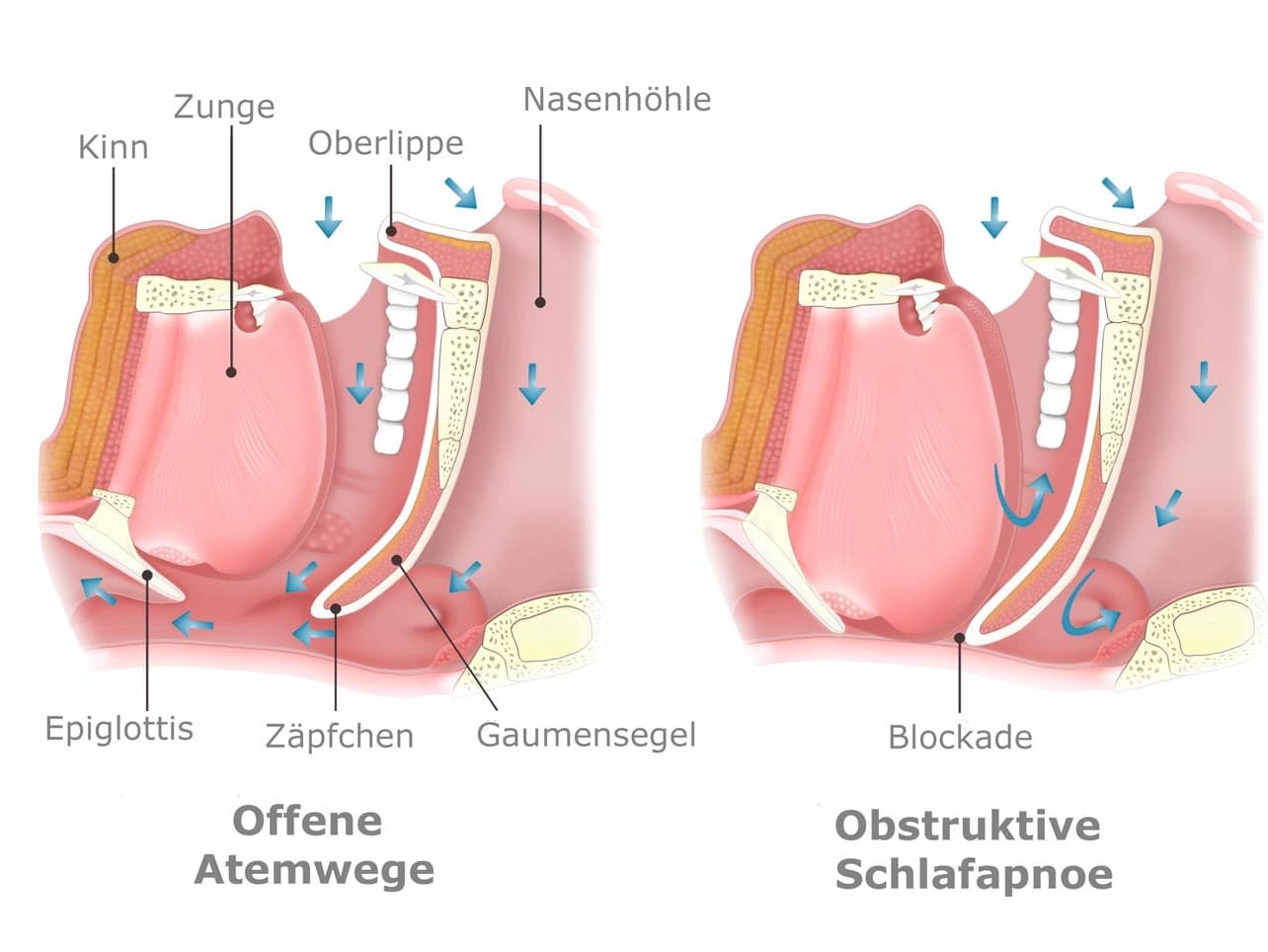 Grafik: Infografik Schlafapnoe