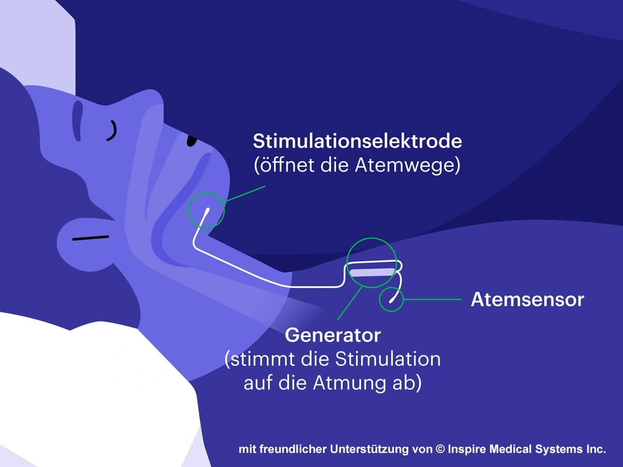 Bild: Infografik zungenschrittmacher