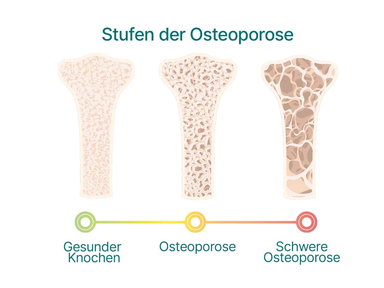 Grafik: Stufen der Osteoporose